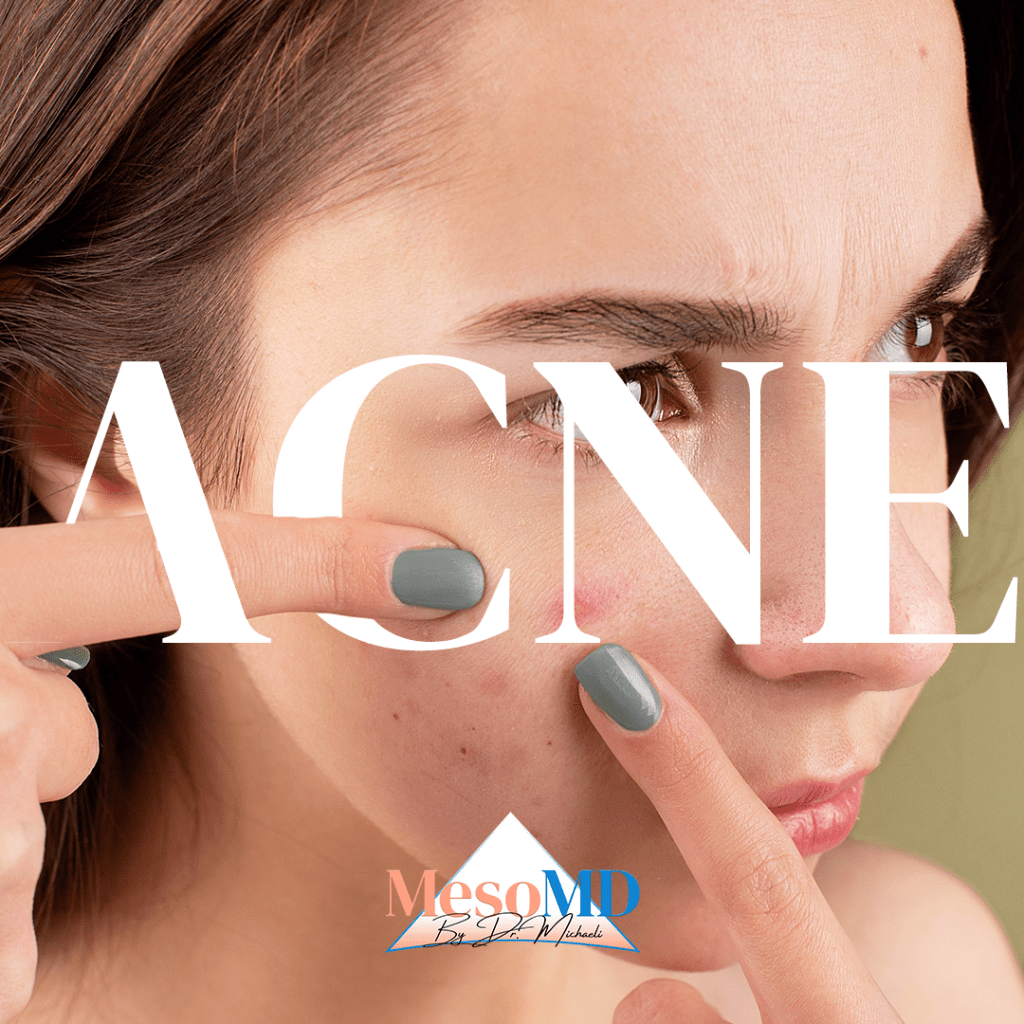 אקנה: סקירה מקיפה של הסוגים השונים, תסמינים, גורמים, אבחון, טיפול ומניעה.